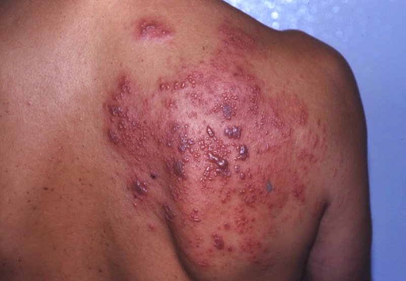 cara menyembuhkan herpes