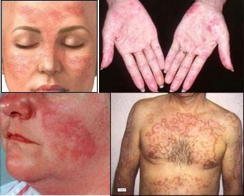What Causes Lupus Anticoagulant Treatment