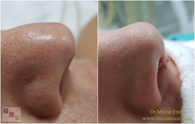 Nose tip plasty with nasal hump reduction operation in İstanbul - Nose tip lifting in İstanbul - Tip plasty in İstanbul - Nose tip reshaping in İstanbul - Nose tip surgery in Turkey - Open technique tip plasty operation in İstanbul