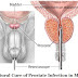 Natural Cure of Prostate Infection in Man