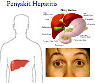 Cara Alami Dan Termudah Untuk Mengobati Penyakit Hepatitis