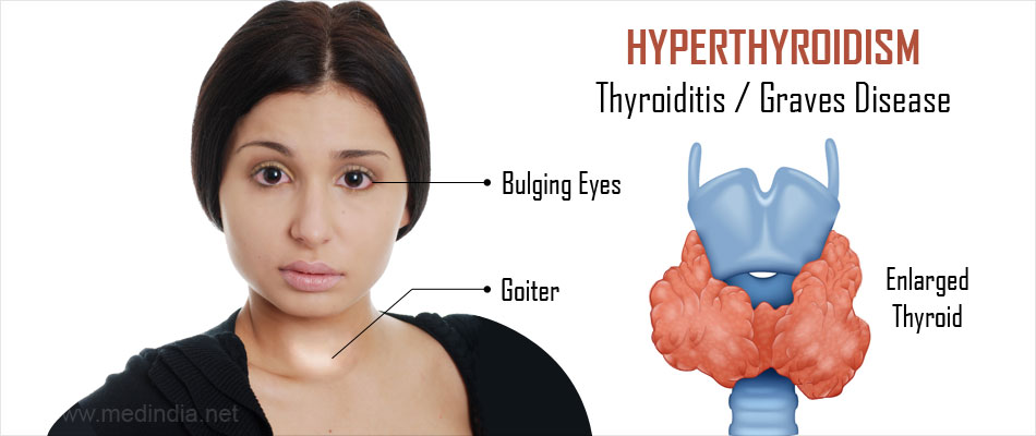 Penghidap Hyperthyroid Ini Mengalami Rambut Gugur 