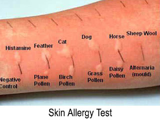 Allergy 