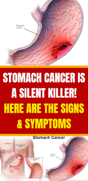 Stomach Cancer Is A Silent Killer! Here Are The Signs & Symptoms