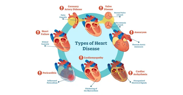 Heart Disease: परिभाषा, लक्षण, कारण व रोकथाम के उपाय