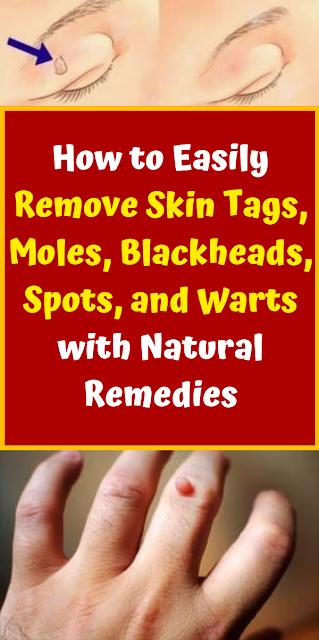 How to Easily Remove Skin Tags, Moles, Blackheads, Spots, and Warts with Natural Remedies