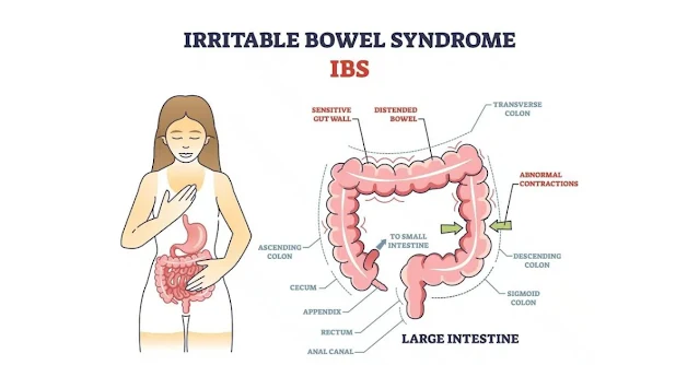Irritable Bowel Syndrome Disease: परिभाषा, IBS के प्रकार, लक्षण व कारण