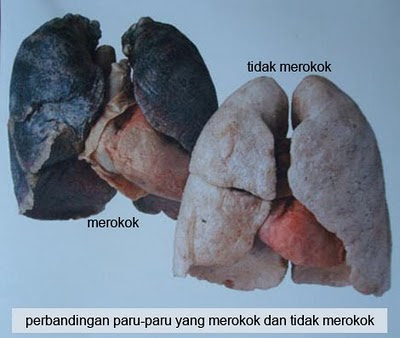 5 Gambar Peparu Bagi Perokok Tegar