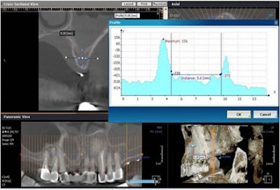 Trước khi cấy ghép implant cần chuẩn bị gì?