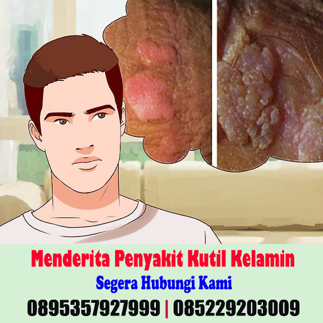 Obat Kutil Kelamin