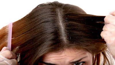 dandruff control