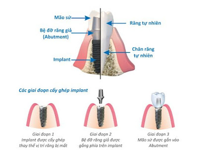 Các bộ phận của răng cấy ghép Implant