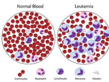 LEUKIMIA : Tanda-tanda Penyakit Kanser Darah dan Tips Rawatannya