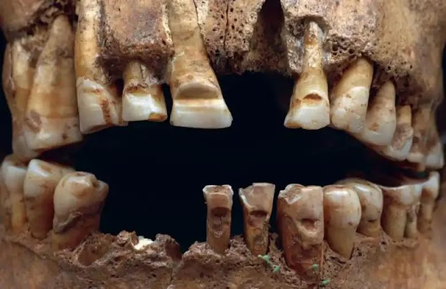 Λεπτομέρεια των δοντιών του άνδρα από τον τάφο 25 στο Slite, κοινότητα Othem του Gotland. [Credit: Lisa Hartzell]