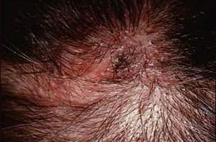 ringworm tkapitis