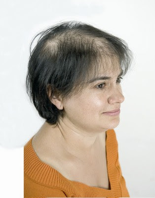 CONOCE QUE ES LA ALOPECIA, QUE LA PRODUCE Y UNA LOCIÓN CACERA PARA APLICARTE.