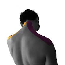 CERVICAL SPONDYLOSIS (SAKIT TULANG LEHER)