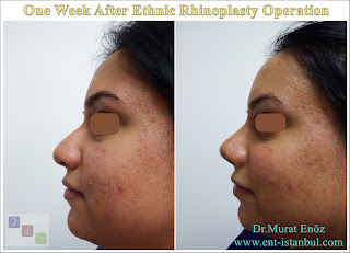 One Week After Ethnic Rhinoplasty Operation