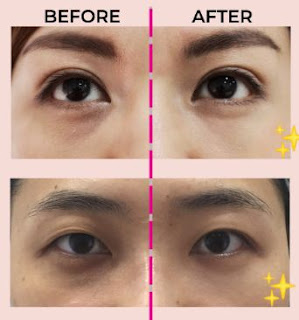 eye bag removal Singapore