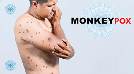 Monkeypox Virus