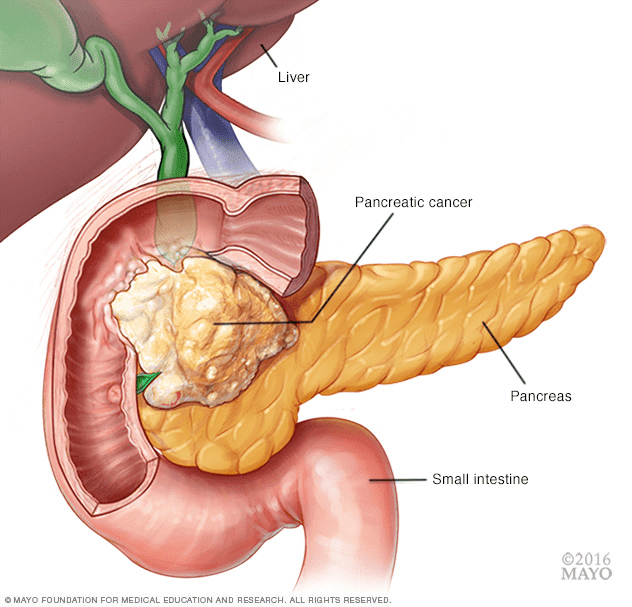 pancreatic-cancer-stage-four