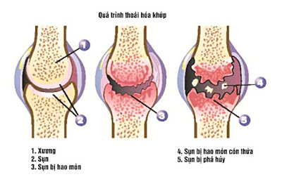 Hậu quả do thoái hóa khớp gây ra