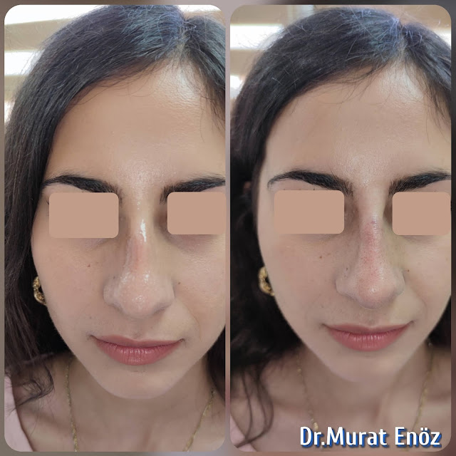 Nose filler injection,Non-surgical rhinoplasty in Turkey,Injectable nose job,Non-surgical nose job,The 5 Minute Nose Job in İstanbul,Liquid Rhinoplasty,
