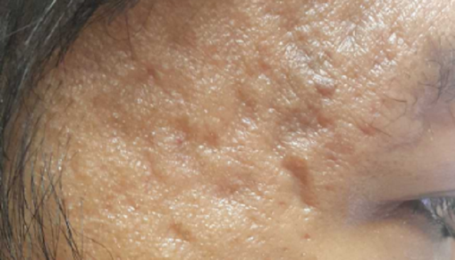  Laser Acne Scar Removal