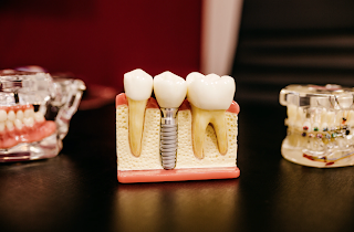 Dental Implants