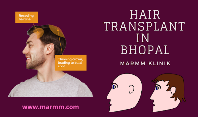 Hair transplant in Bhopal