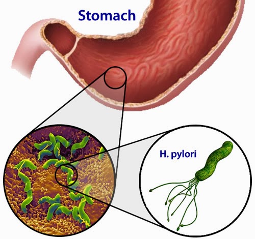 Punca, Simptom dan Penawar Penyakit Gastrik  VItamin 