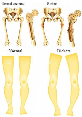 Pengobatan Herbal Rickets Tradisional