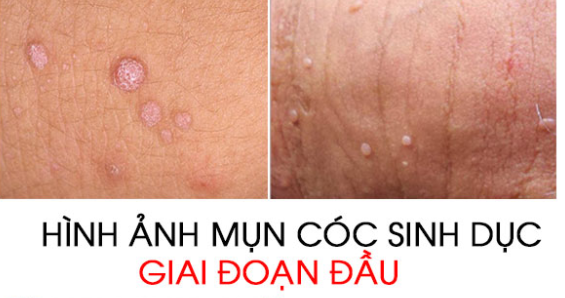 Hình ảnh mụn cóc sinh dục ở nam và nữ