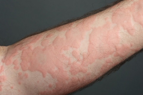 bentol di kulit akibat alergi