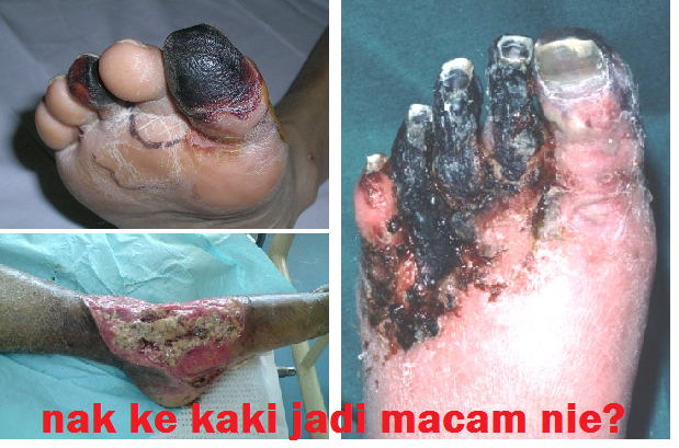 Kencing Manis Potong Kaki  Jelitawan Collections