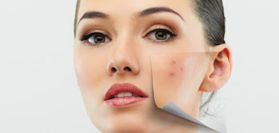 Acne treatment for oily skin naturally