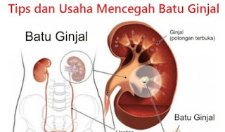 cara menghancurkan batu ginjal tanpa operasi,obat batu ginjal,obat kencing batu,cara mengeluarkan batu ginjal tanpa operasi,cara menghilangkan batu ginjal tanpa operasi