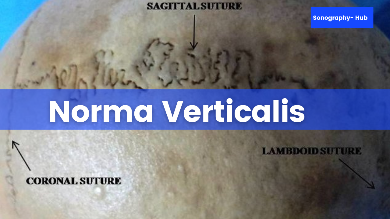 Norma Verticalis- Exterior of the skull