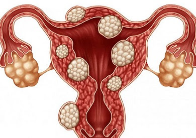 اساب وعلاج تكيس المبايض