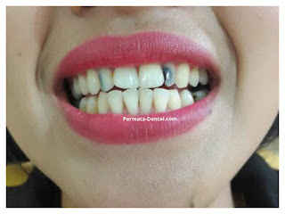 foto, gambar, gigi depan hitam Permata Dental Bali| sebelum dan sesudah gigi hitam diperbaiki di Permata Dental Bali | foto gigi keropos hitam Permata Dental Bali |gigi hitam karena sakit | gigi hitam berlubang di Permata Dental Bali | gigi hitam depan di Permata Dental Bali | gigi hitam bagian belakang | foto gigi hitam yang sudah diperbaiki Permata Dental Bali |  gigi hitam bagian depan| foto gigi keropos dan hitam, foto gigi hitam oleh Permata Dental Bali , Bali Hits, Bali banget, area Bali, Bali  kota, area kampus Bali. veneer gigi hitam Bali | gambar sebelum dan sesudah veneer gigi hitam dan berlubang  veneer gigi hitam Bali | veneer gigi hitam denpasar| veneer gigi hitam nusadua | veneer gigi hitam ngurahrai| veneer gigi hitam badung| veneer gigi hitam jember jimbaran| veneer gigi hitam gatsu| veneer gigi hitam bali | veneer gigi hitam bagus di Permata Dental Bali | veneer gigi hitam baik di Permata Dental Bali | veneer gigi hitam cepat di Permata Dental Bali | veneer gigi hitam murah di Permata Dental Bali | veneer gigi hitam aman di Permata Dental Bali | veneer gigi hitam mudah di Permata Dental Bali | veneer gigi hitam promo Permata Dental Bali | gambar veneer gigi hitam Permata Dental Bali | gambar sebelum dan sesudah veneer gigi hitam dan berlubang Permata Dental Bali | veneer gigi hitam bagus | veneer gigi hitam baik | veneer gigi hitam cepat | veneer gigi hitam murah| veneer gigi hitam aman | veneer gigi hitam mudah  | veneer gigi hitam promo | gambar veneer gigi hitam | gambar sebelum dan sesudah veneer gigi hitam dan berlubang Permata Dental Bali | foto veneer gigi hitam Permata Dental Bali |perbaiki gigi hitam Permata Dental Bali | cara mengatasi gigi hitam Permata Dental Bali | menghilangkan gigi hitam Permata Dental Bali | cara menghilangkan gigi hitam Permata Dental Bali | cara memutihkan  gigi hitam Permata Dental Bali | membantu menghilangkan gigi hitam Permata Dental Bali | perbaiki Permata Dental Bali | harga perbaiki gigi hitam Permata Dental Bali | perbaiki gigi hitam murah  Permata Dental Bali | perbaiki gigi hitam promo Permata Dental Bali | perbaiki gigi hitam bagus Permata Dental Bali | perbaiki gigi hitam  aman Permata Dental Bali | perbaiki gigi hitam cepat  Permata Dental Bali | perbaiki gigi hitam mudah Permata Dental Bali | harga perbaiki gigi hitam mudah Permata Dental Bali | perbaiki gigi hitam Permata Dental Bali |proses perbaiki gigi hitam mudah Permata Dental Bali | foto perbaiki gigi hitam Permata Dental Bali | gambar perbaiki gigi hitam Permata Dental Bali | perbaiki gigi hitam mudah Permata Dental Bali | perbaiki  gigi hitam bali| perbaiki  gigi hitam denpasar  | perbaiki  gigi hitam nusadua| perbaiki  gigi hitam badung| perbaiki  gigi hitam ngurahrai| perbaiki  gigi hitam gatsu| perbaiki  gigi hitam jimbaran| perbaiki  gigi hitam tabanan| perbaiki  gigi hitam