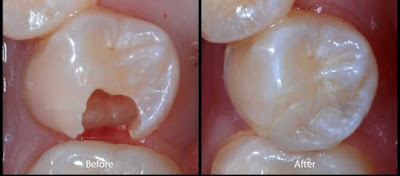 Lo lắng lỗ sâu răng to có trám được không của người bệnh-2