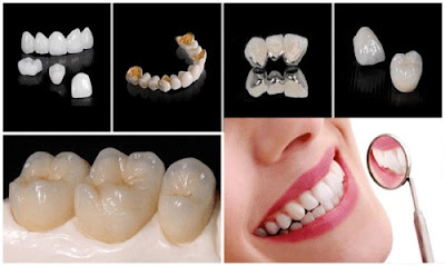 Bọc răng sứ cho răng mọc lệch có hiệu quả không? 