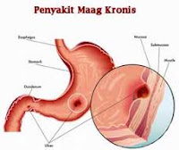 Obat Herbal Maag Kronis