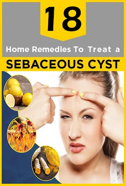 18 Remedies to Remove Sebaceous Cyst Naturally at Home (Fast & Easy)