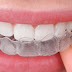 Ưu điểm của niềng răng bằng nhựa