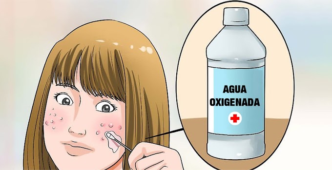 Cómo usar el agua oxigenada para quitar las manchas y el acné de la cara