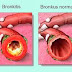 Pengobatan Penyakit Bronkitis Secara Alami