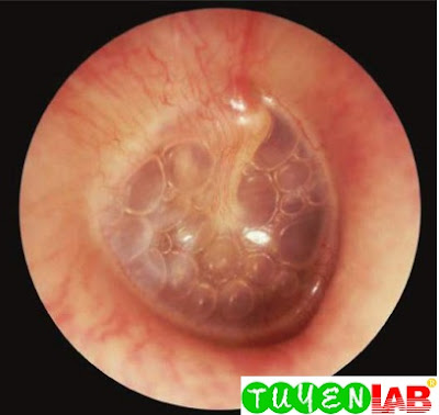 Otitis media with effusion (OME) in the right ear