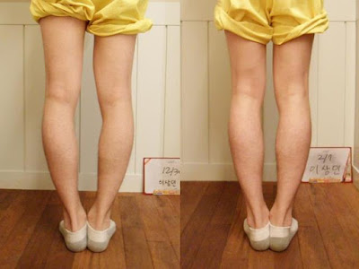 Bow Legs Correction, Bow Legs Correction without Surgery