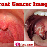 Cancer of the throat: symptoms causes and cure